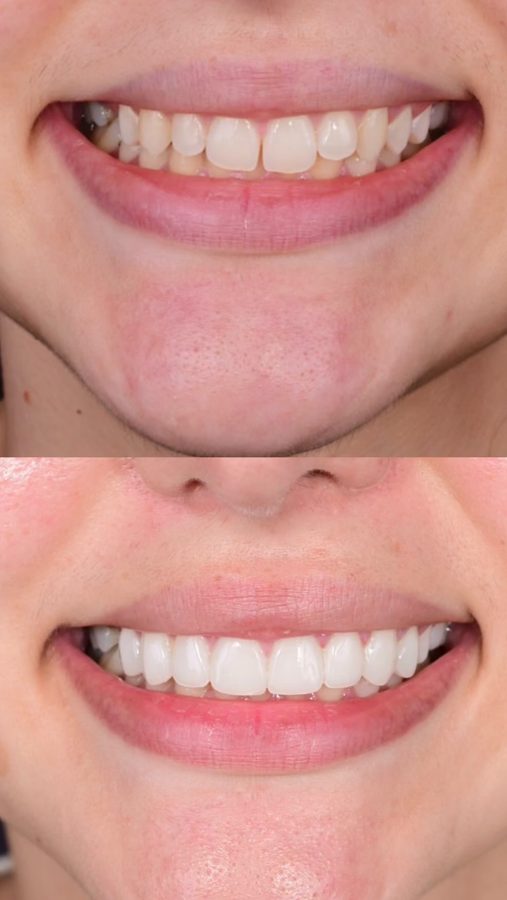 Before and after Porcelain Veneers — patient of Dr. Ali Esfahani, Century City