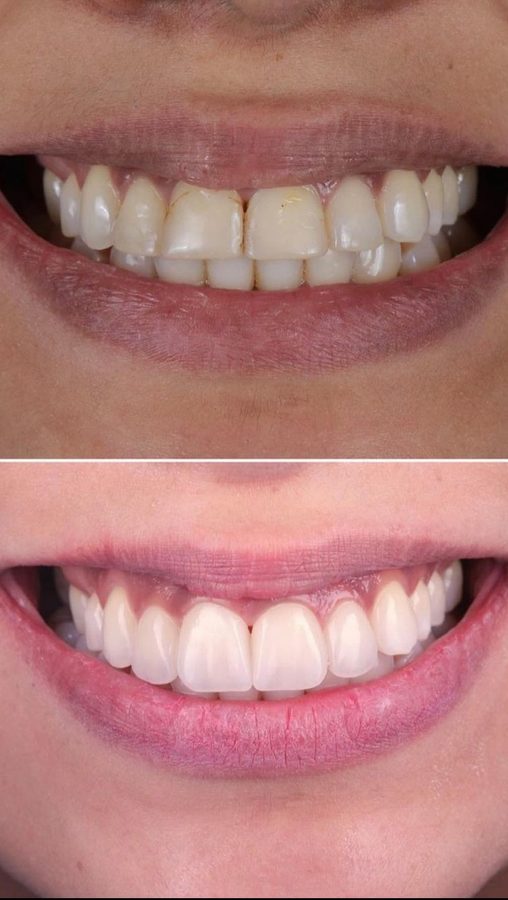 Before and after Porcelain Veneers — patient of Dr. Ali Esfahani, Century City