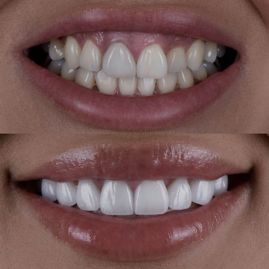 Before and after Smile Makeover — patient of Dr. Ali Esfahani, Century City