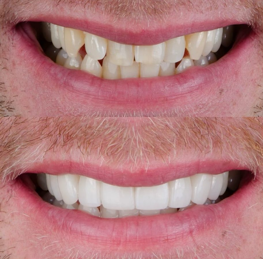 Before and after Veneers & Whitening — patient of Dr. Ali Esfahani, Century City