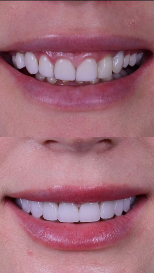 Before and after Porcelain Veneers — patient of Dr. Ali Esfahani, Century City