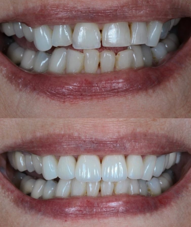 Before and after Full-Mouth Restoration — patient of Dr. Ali Esfahani, Century City