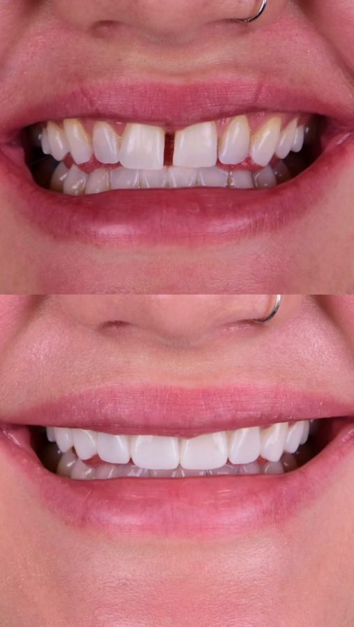 Before and after Gap Closure — patient of Dr. Ali Esfahani, Century City