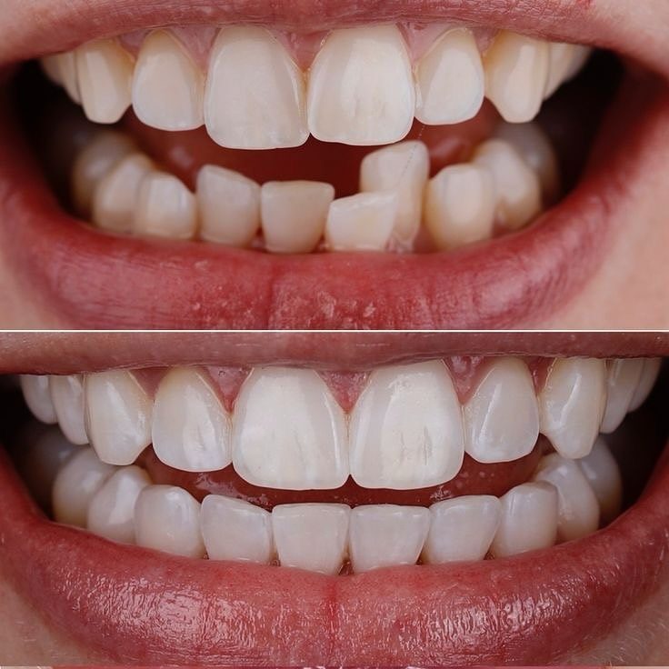Before and after Teeth Alignment — patient of Dr. Ali Esfahani, Century City