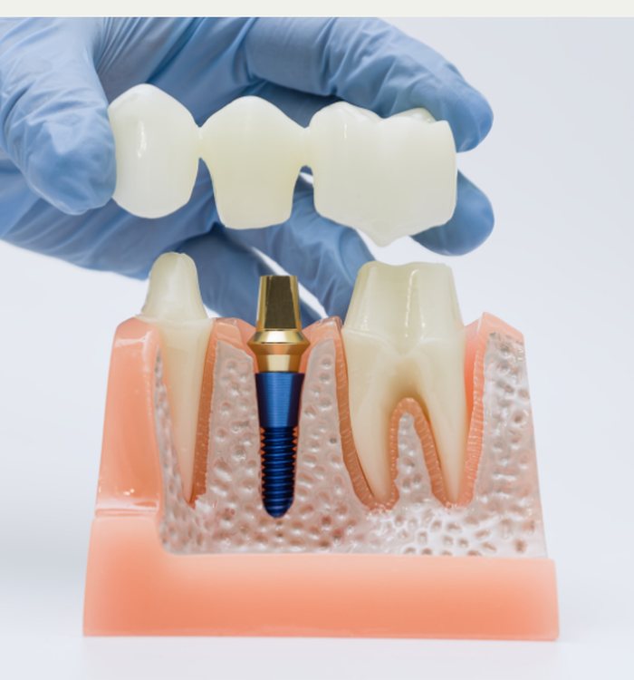 Dental Implants — Century City dental care