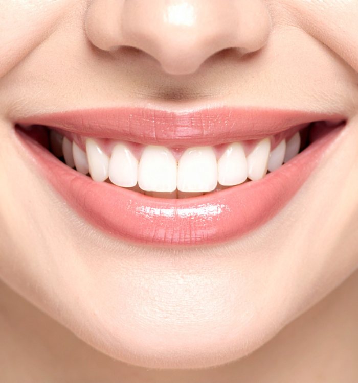 Teeth Whitening — Century City dental care
